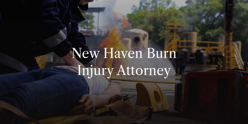 New Haven Burn Injury Attorney